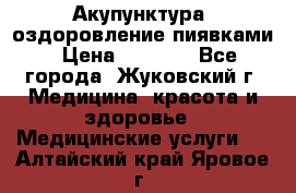 Акупунктура, оздоровление пиявками › Цена ­ 3 000 - Все города, Жуковский г. Медицина, красота и здоровье » Медицинские услуги   . Алтайский край,Яровое г.